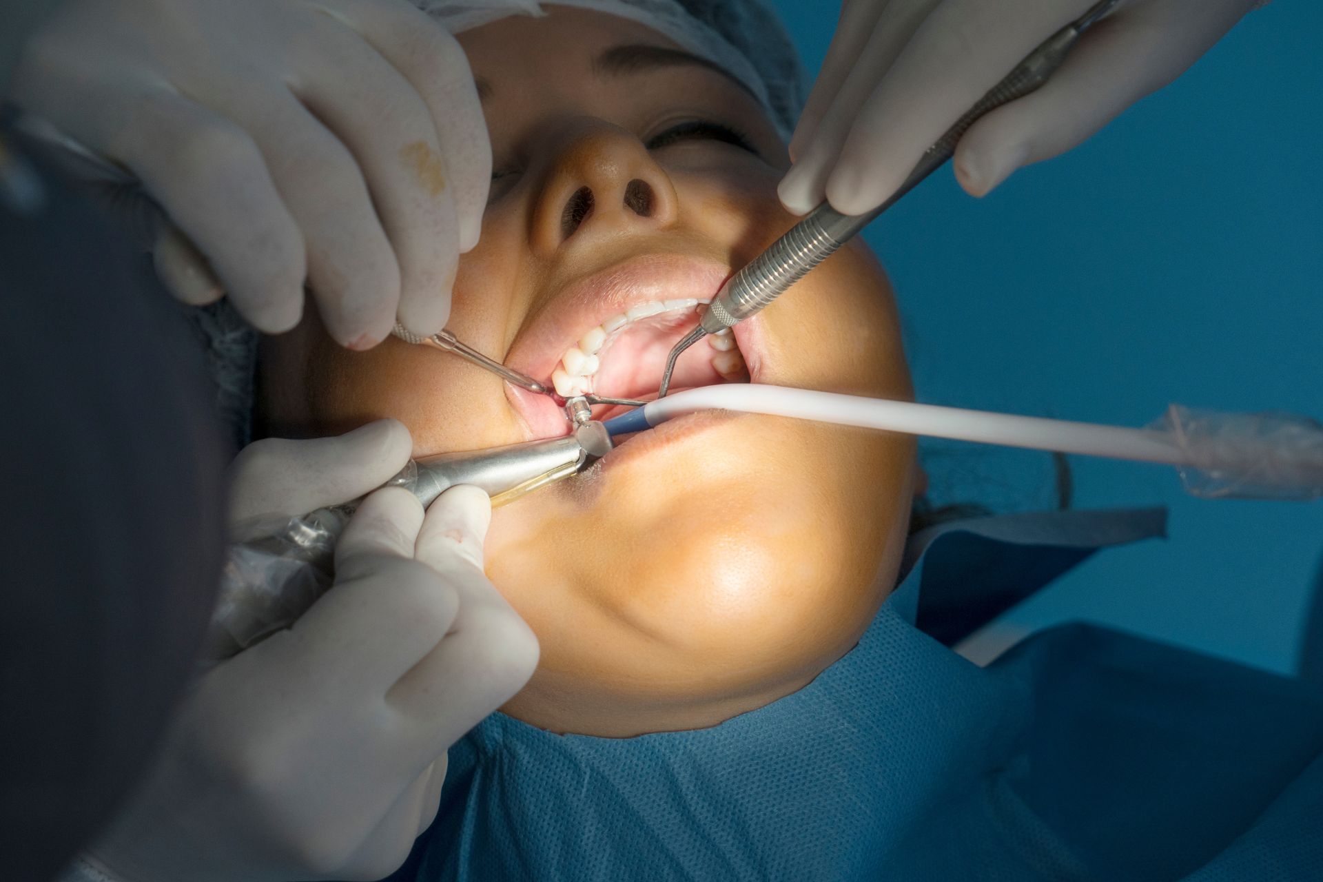 Colocação de implantes dentários na Clínica do Chapim
